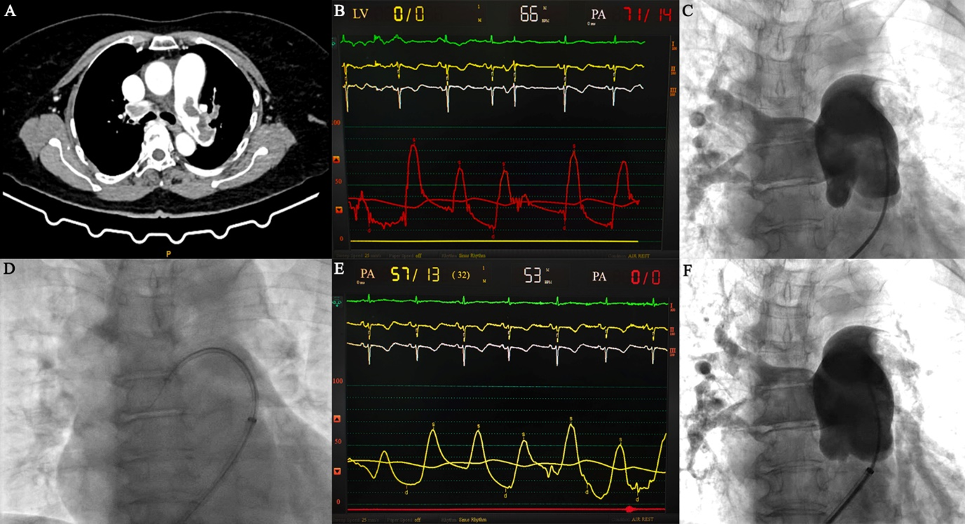 Figure 2. (A) Repeat cardiac computed tomography
