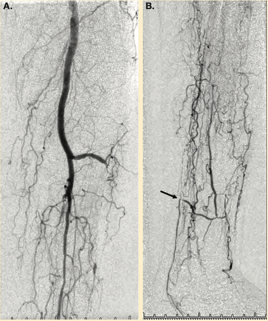 Mustapha Infrainguinal CTO Figure 1