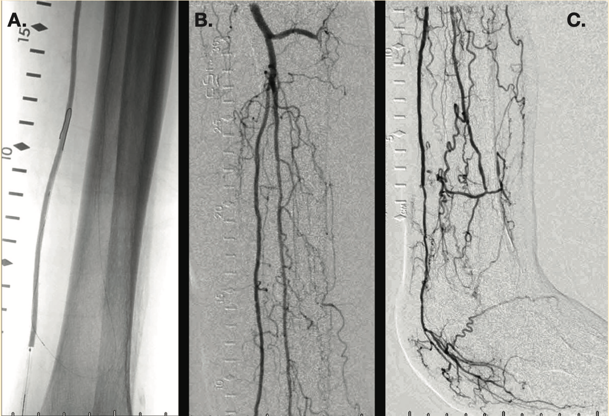 Mustapha Infrainguinal CTO Figure 3