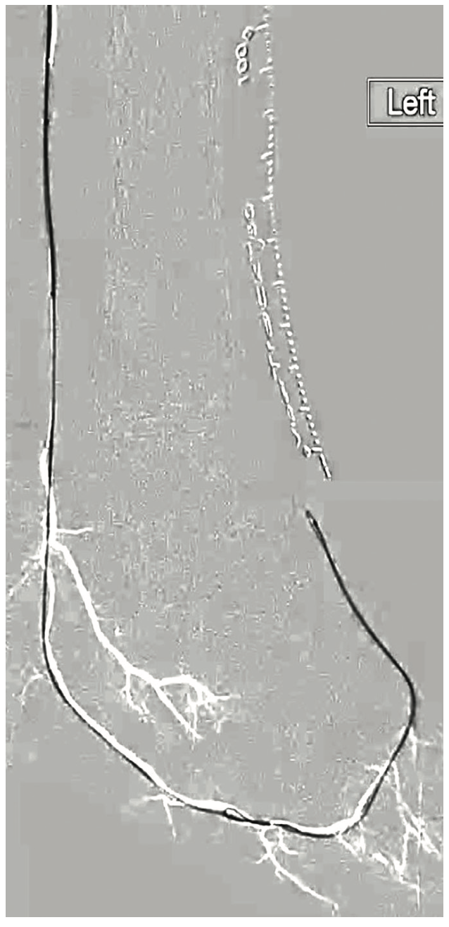 Mustapha Plantar Circulation Figure 5
