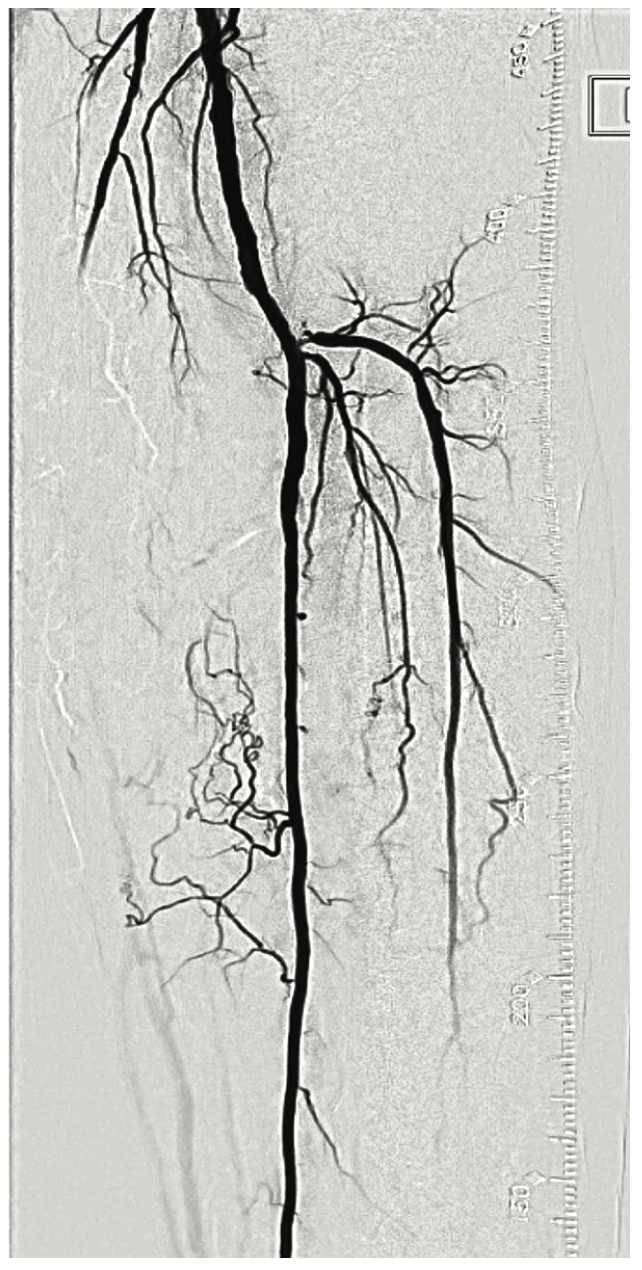 Mustapha Plantar Circulation Figure 7