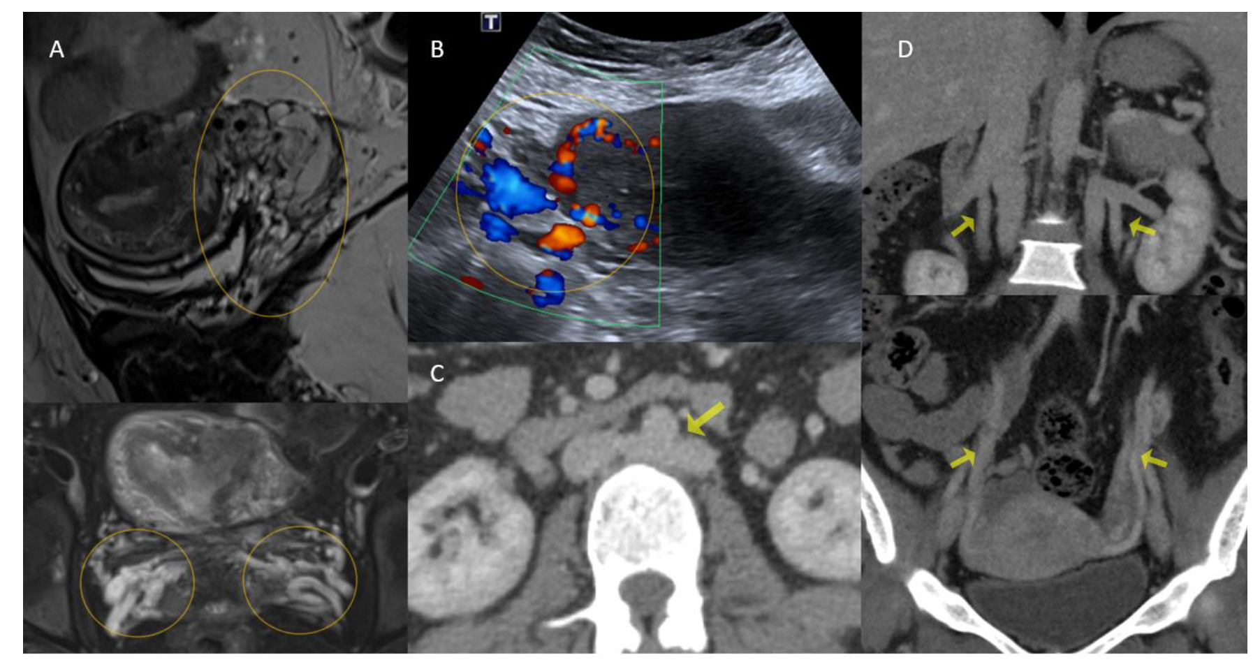 Figure 1.  (A) Sagittal T2 and axial short-tau inversion recovery sections and (B) axial pelvic ultrasound image showing dilated parametrial and pelvic veins (encircled yellow line). (C) Axial contrast-enhanced computed tomography (CECT) section depicting the retroaortic course of the connector vein (presumed to exist as a nutcracker syndrome counterpart). (D) Coronal CECT sections showing dilated gonadal veins (R and L) joining the respective renal veins that eventually drain into the right and left inferior vena cava and the gonadal veins near their origin from the ovarian plexus. 