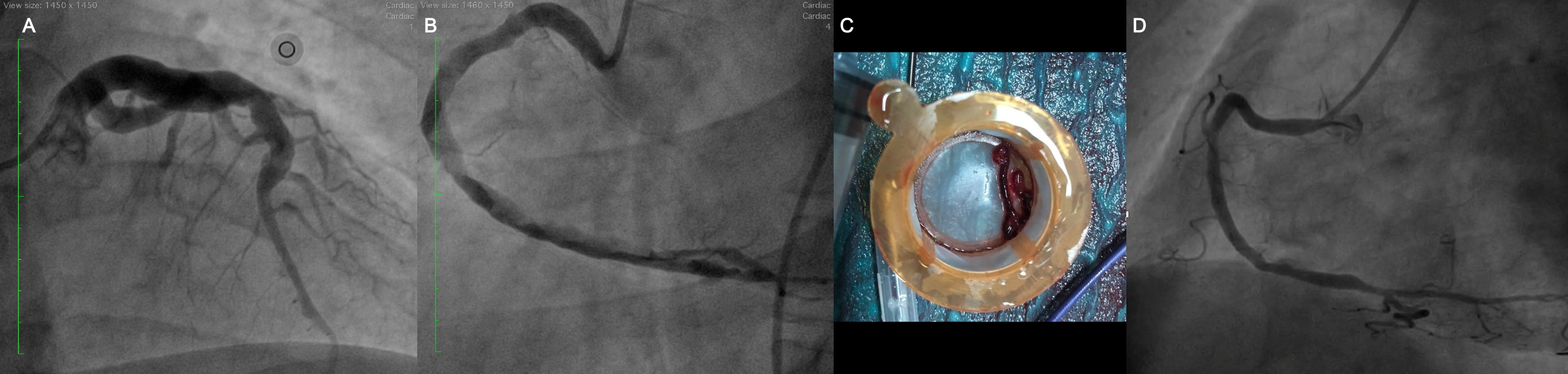 Figure. (A) Coronary angiography