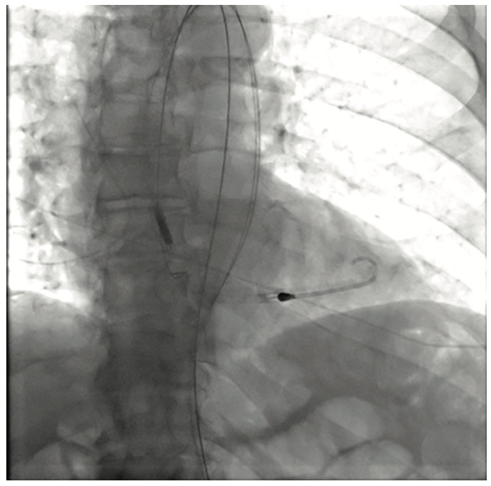 Nabet Impella-Assisted PCI Figure 1