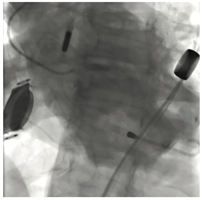 Nabet Impella-Assisted PCI Figure 2