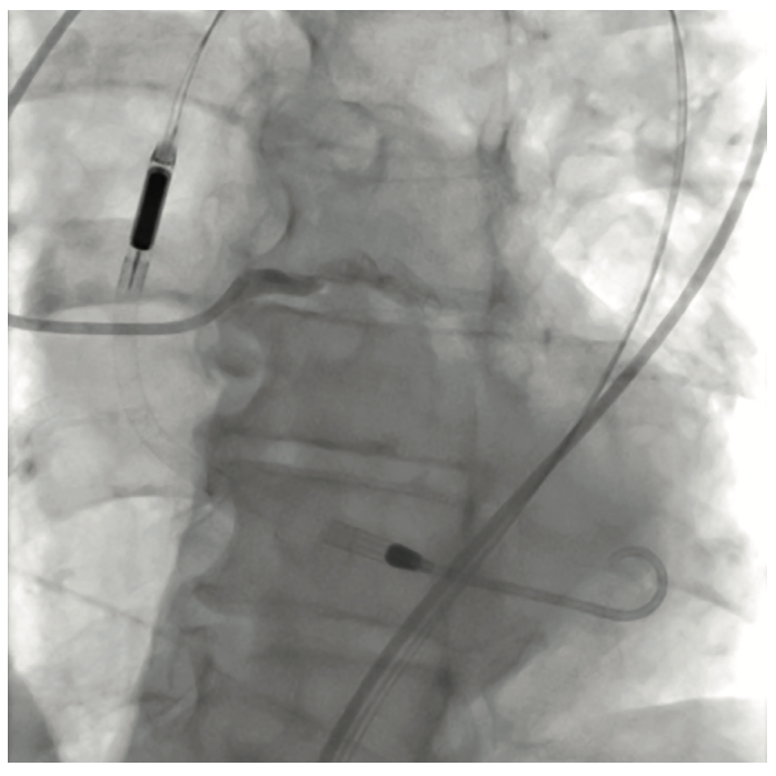 Nabet Impella-Assisted PCI Figure 3