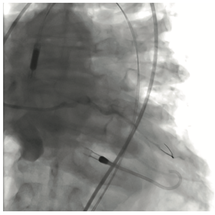Nabet Impella-Assisted PCI Figure 4