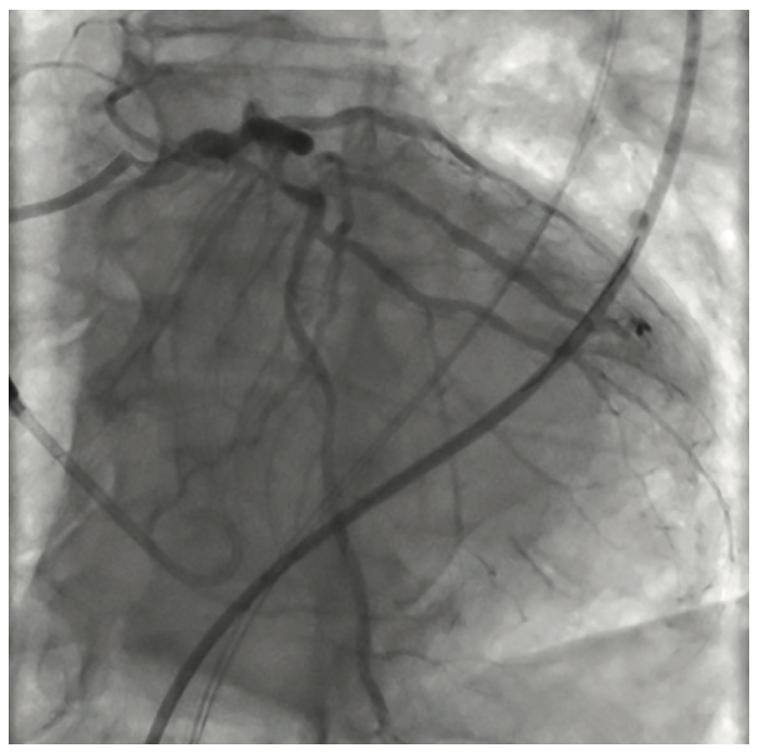 Nabet Impella-Assisted PCI Figure 5