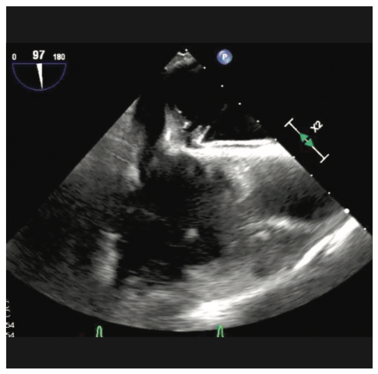 Nadkarni Transseptal Access Figure 2