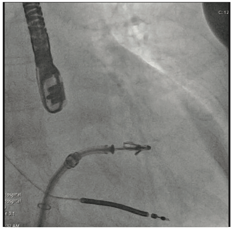 Nadkarni Transseptal Access Figure 3