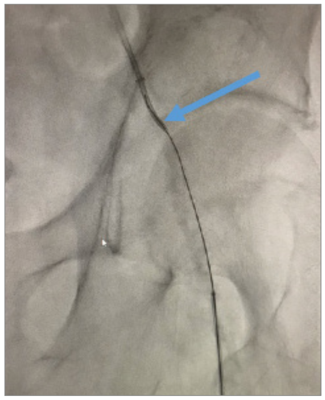 Nagel CTO Crossing Figure 4