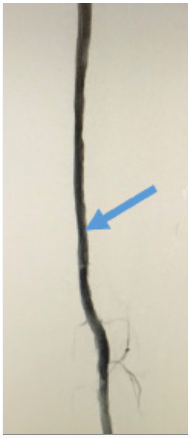 Nagel CTO Crossing Figure 8