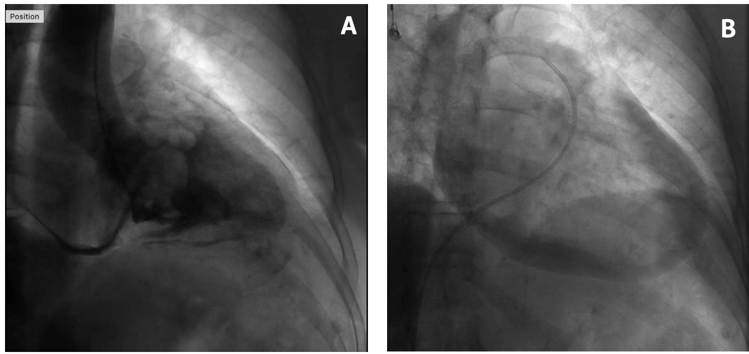 Nandal Left Heart Catheterization Figure 1