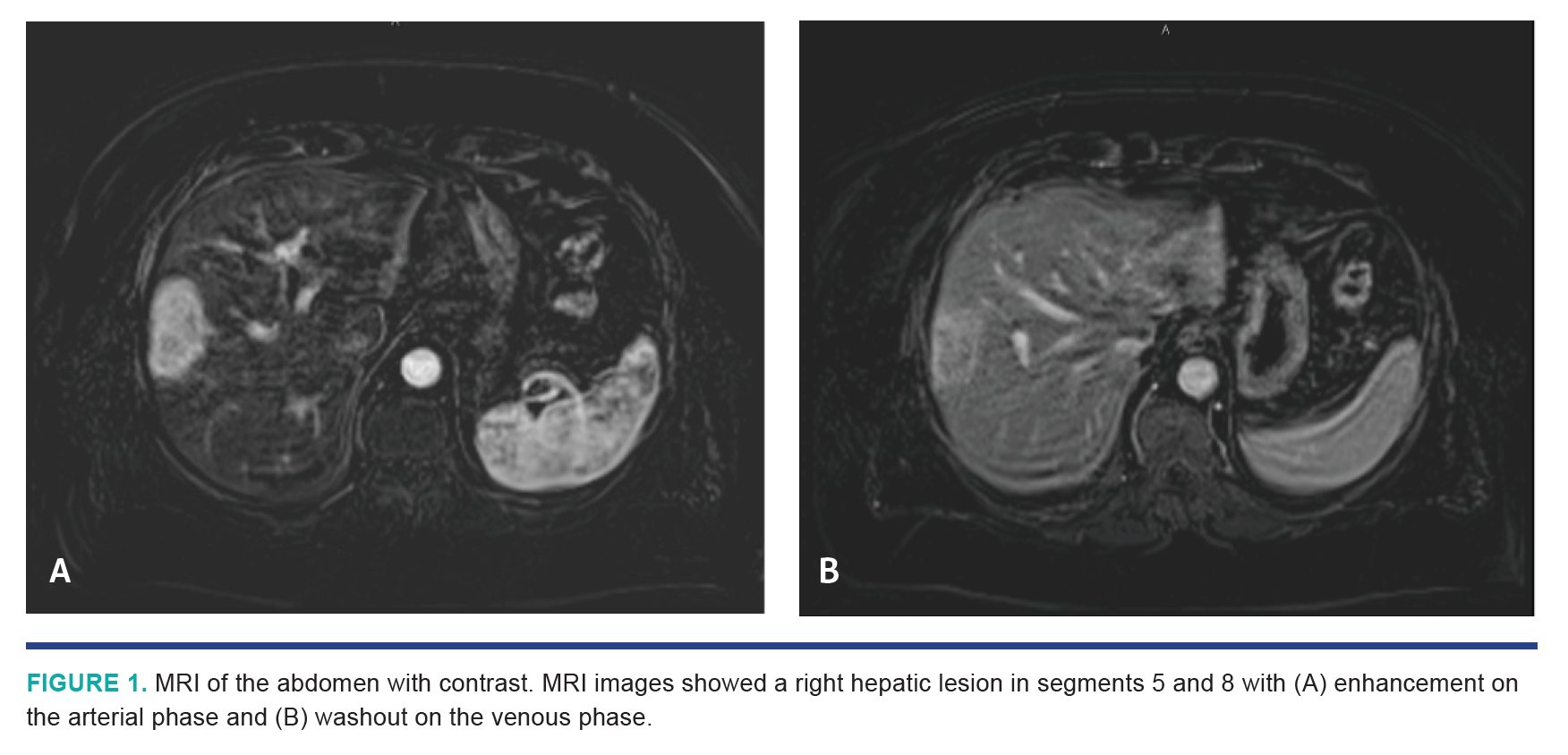 Nezami HCC Segmentectomy Fig 1