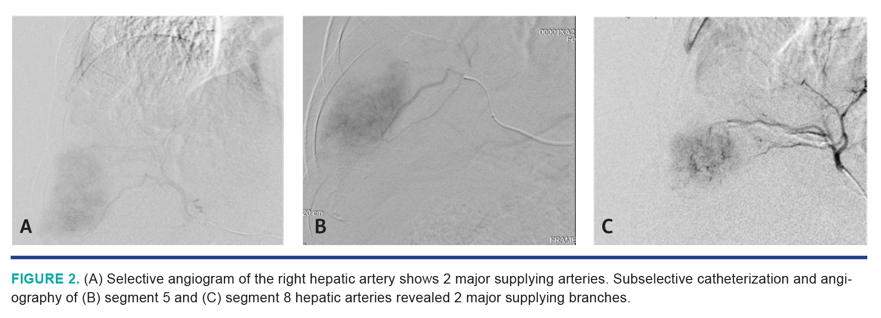 Nezami HCC Segmentectomy Fig 2