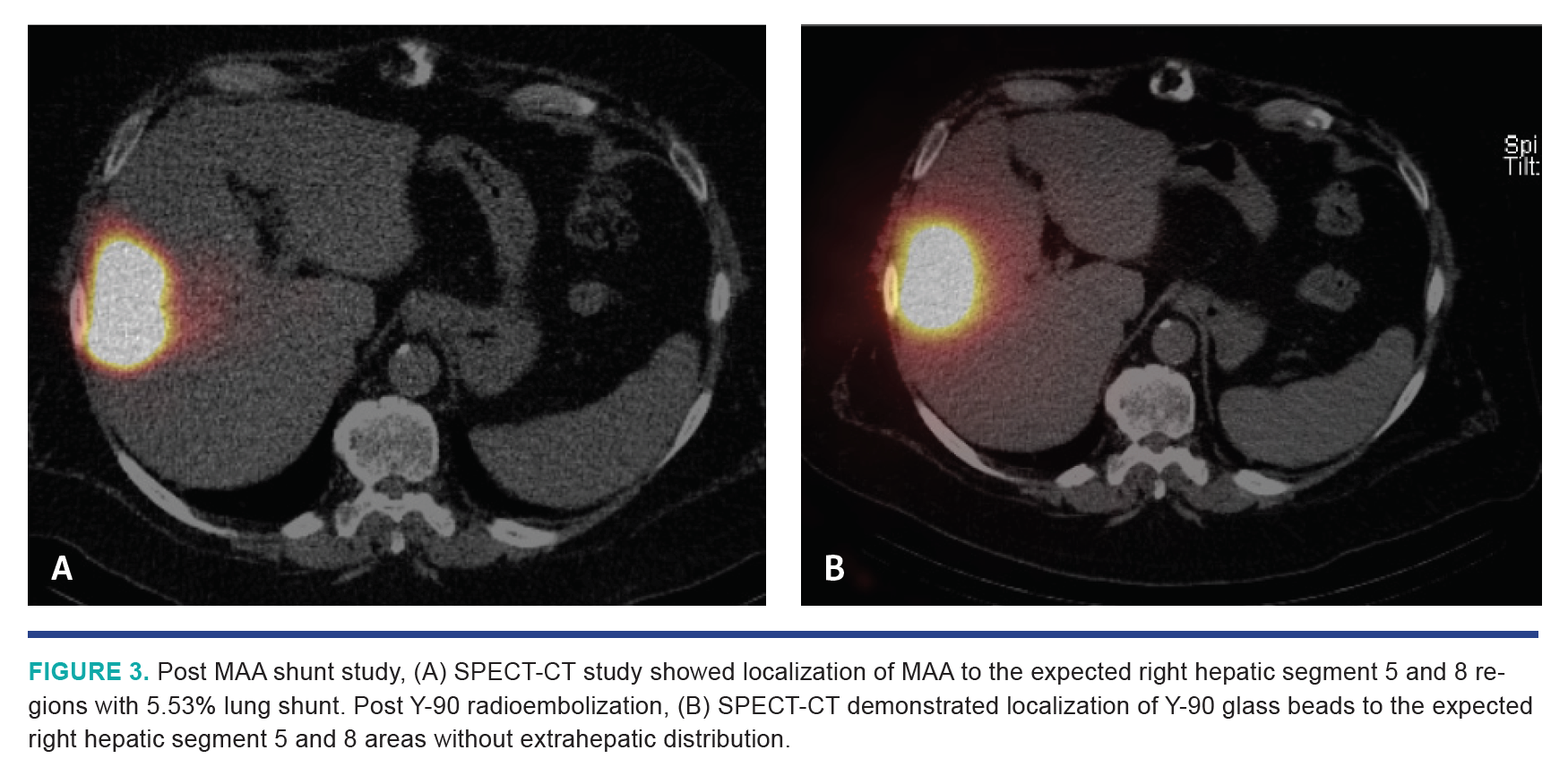 Nezami HCC Segmentectomy Fig 3