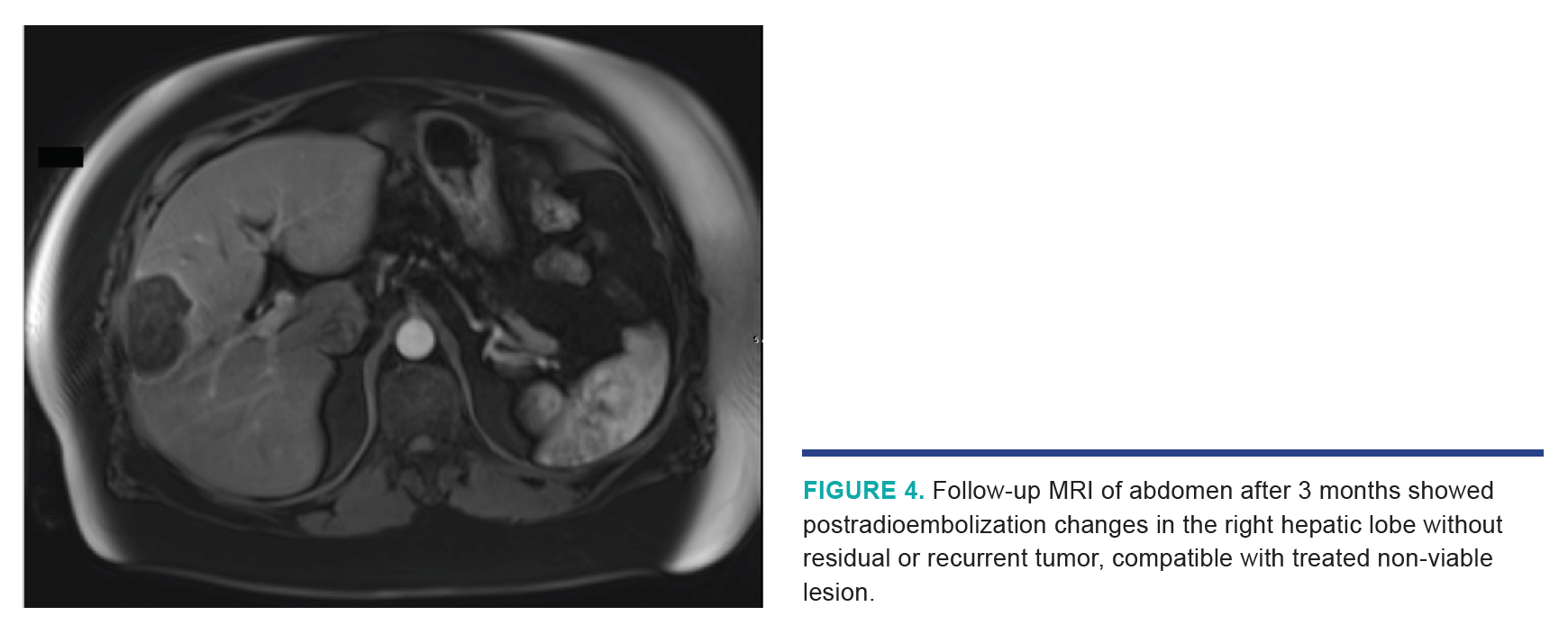 Nezami HCC Segmentectomy Fig 4