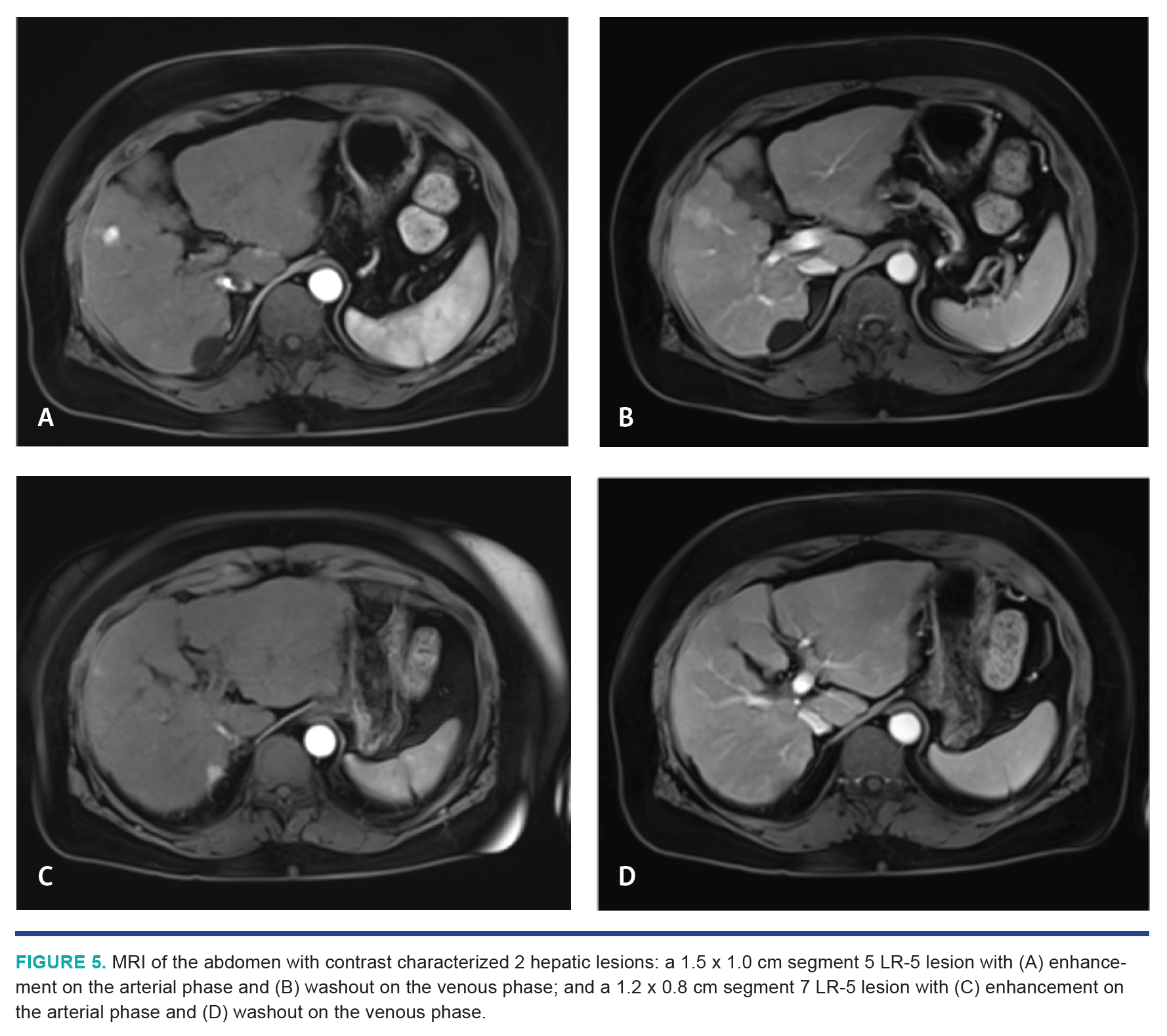 Nezami HCC Segmentectomy Fig 5