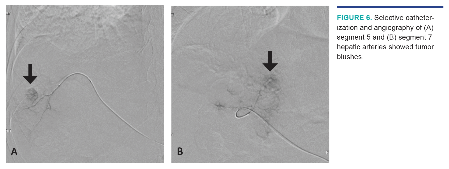 Nezami HCC Segmentectomy Fig 6