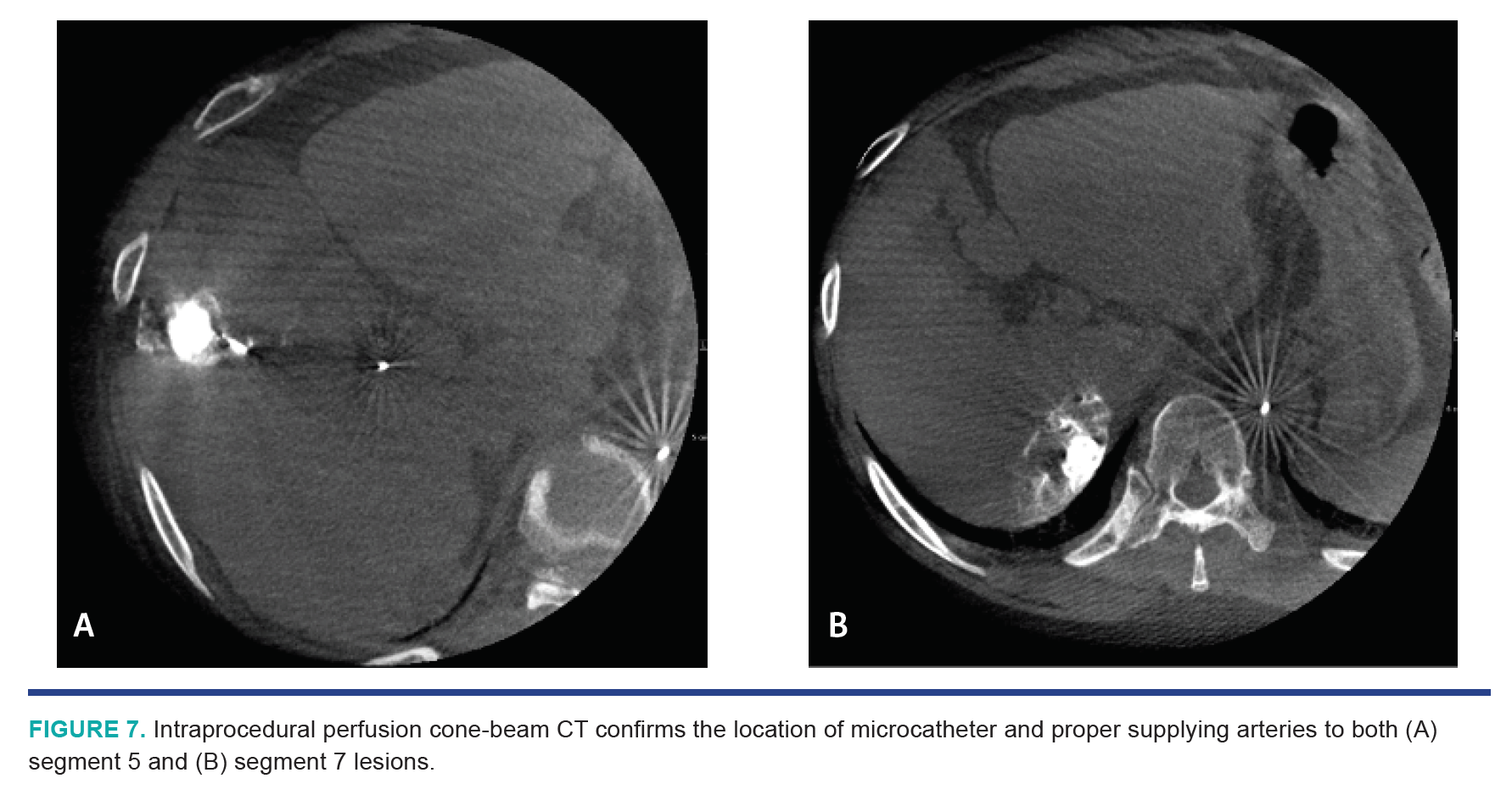Nezami HCC Segmentectomy Fig 7