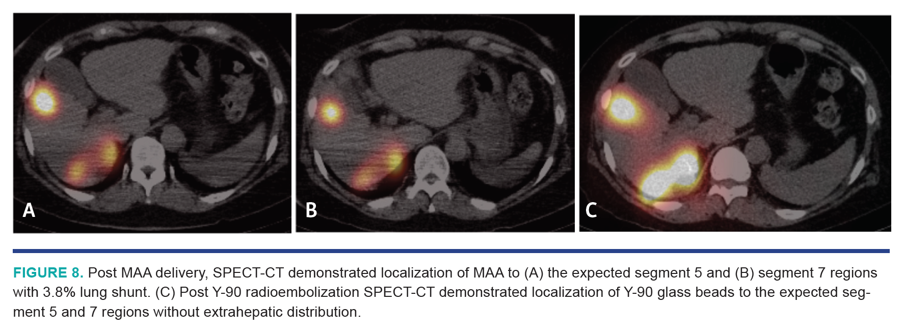 Nezami HCC Segmentectomy Fig 8