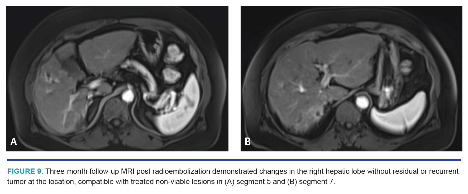 Nezami HCC Segmentectomy Fig 9