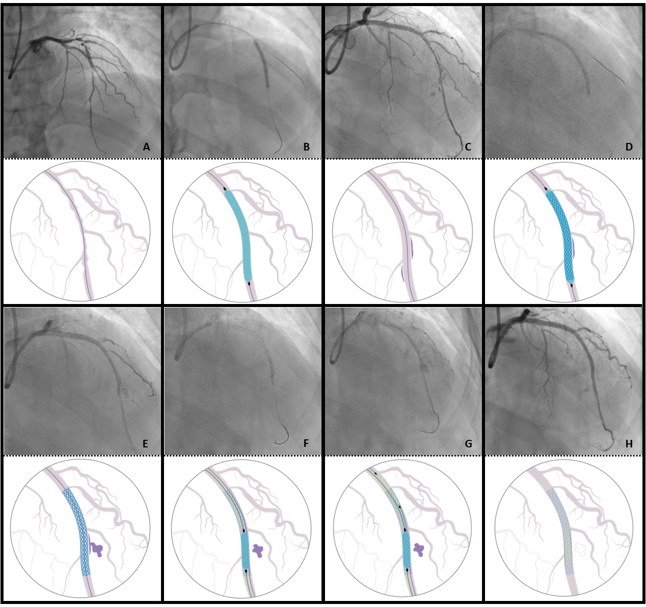 Figure 1. Case summary. (A) A basal angiogram. 