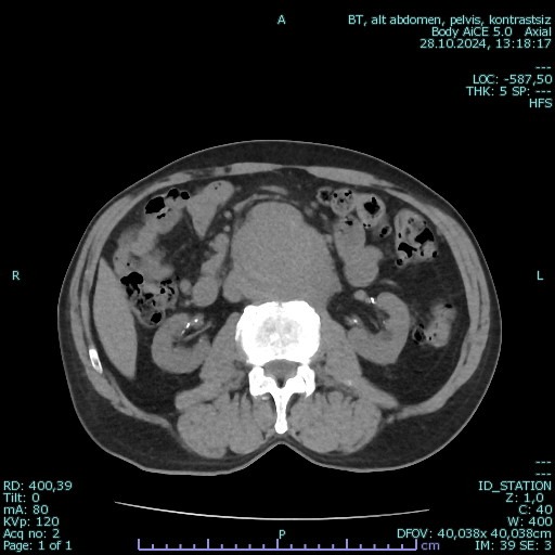 Figure 1. Computed tomography (CT) image demonstrating the infrarenal abdominal aortic aneurysm.