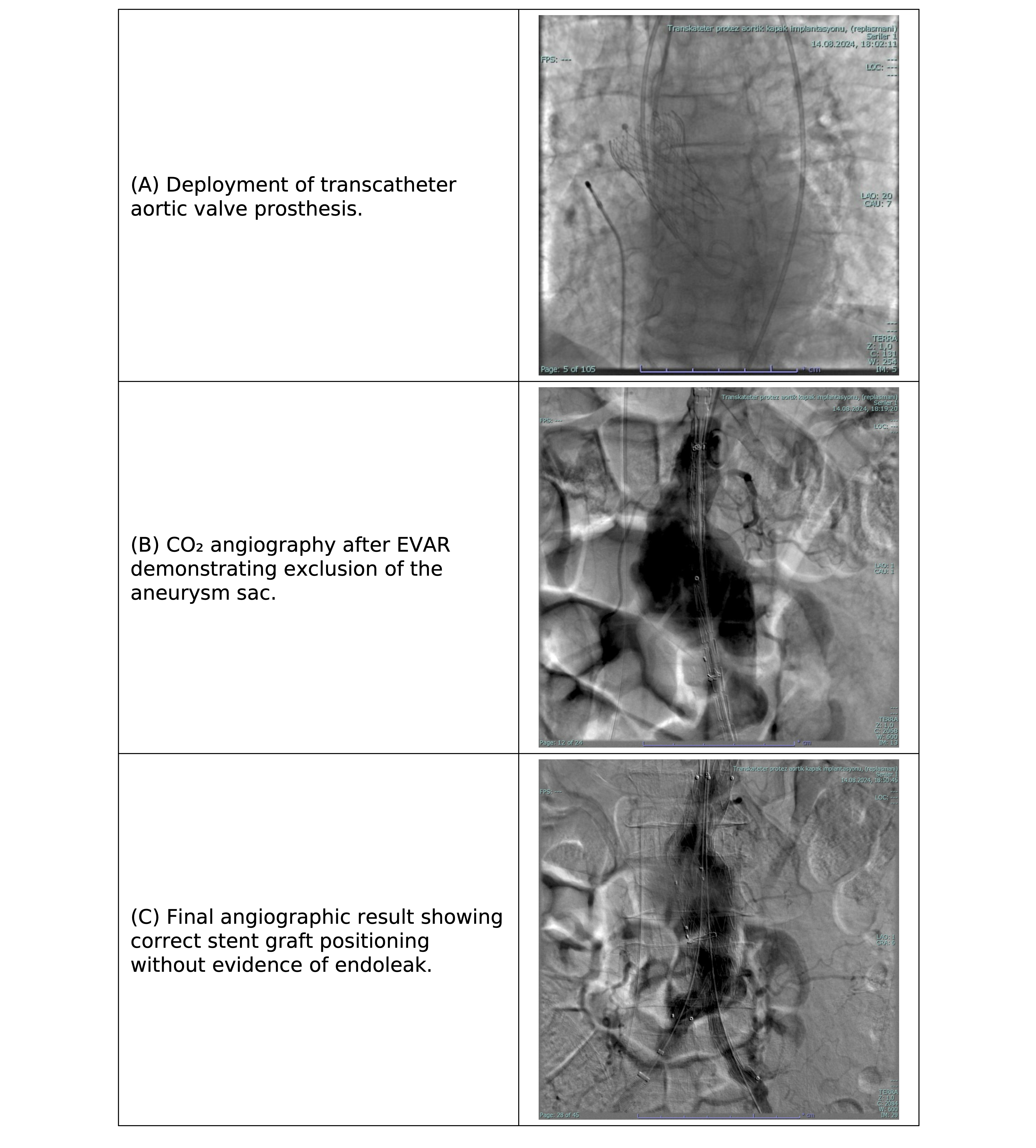 Figure 2. Angiographic images during simultaneous TAVI and EVAR procedure. (A) Deployment of transcatheter aortic valve prosthesis. (B) CO₂ angiography after EVAR demonstrating exclusion of the aneurysm sac. (C) Final angiographic result showing correct stent graft positioning without evidence of endoleak.