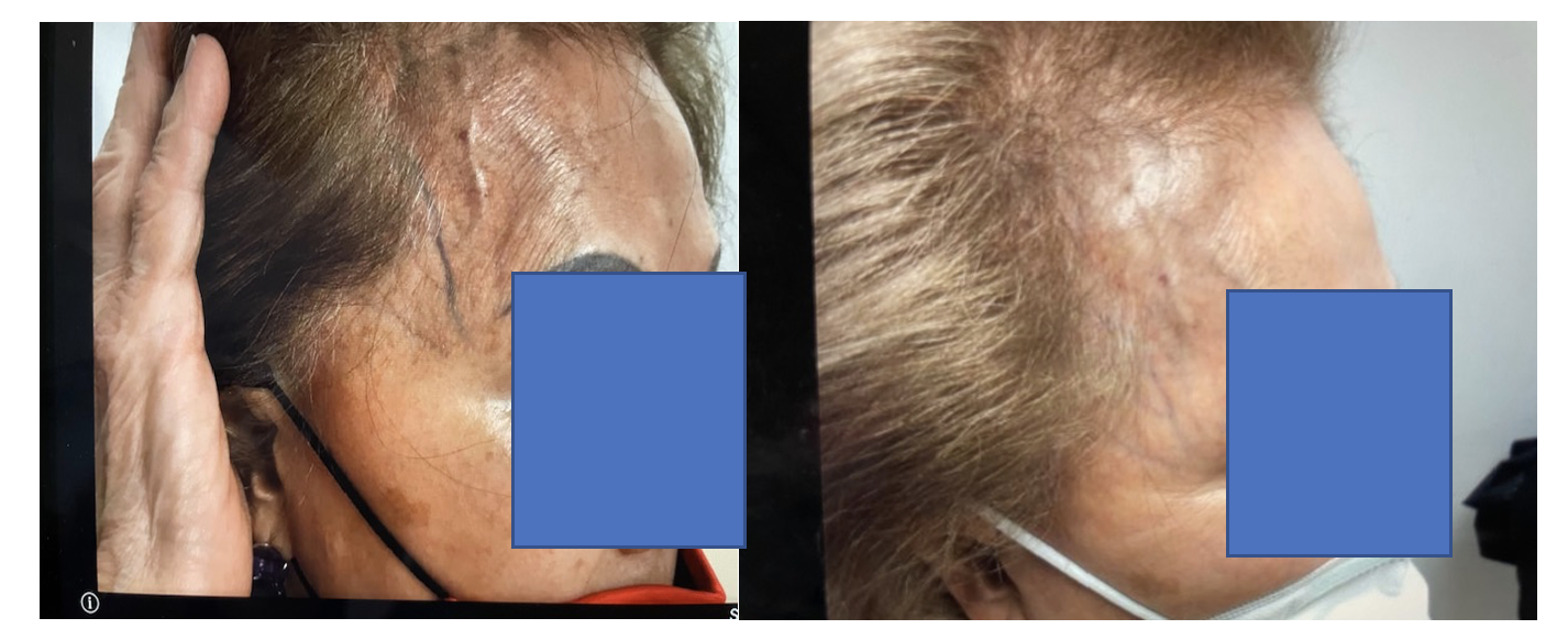 Figure. An 82-year-old woman before sclerotherapy (left) and after a 6-week follow-up period (right).