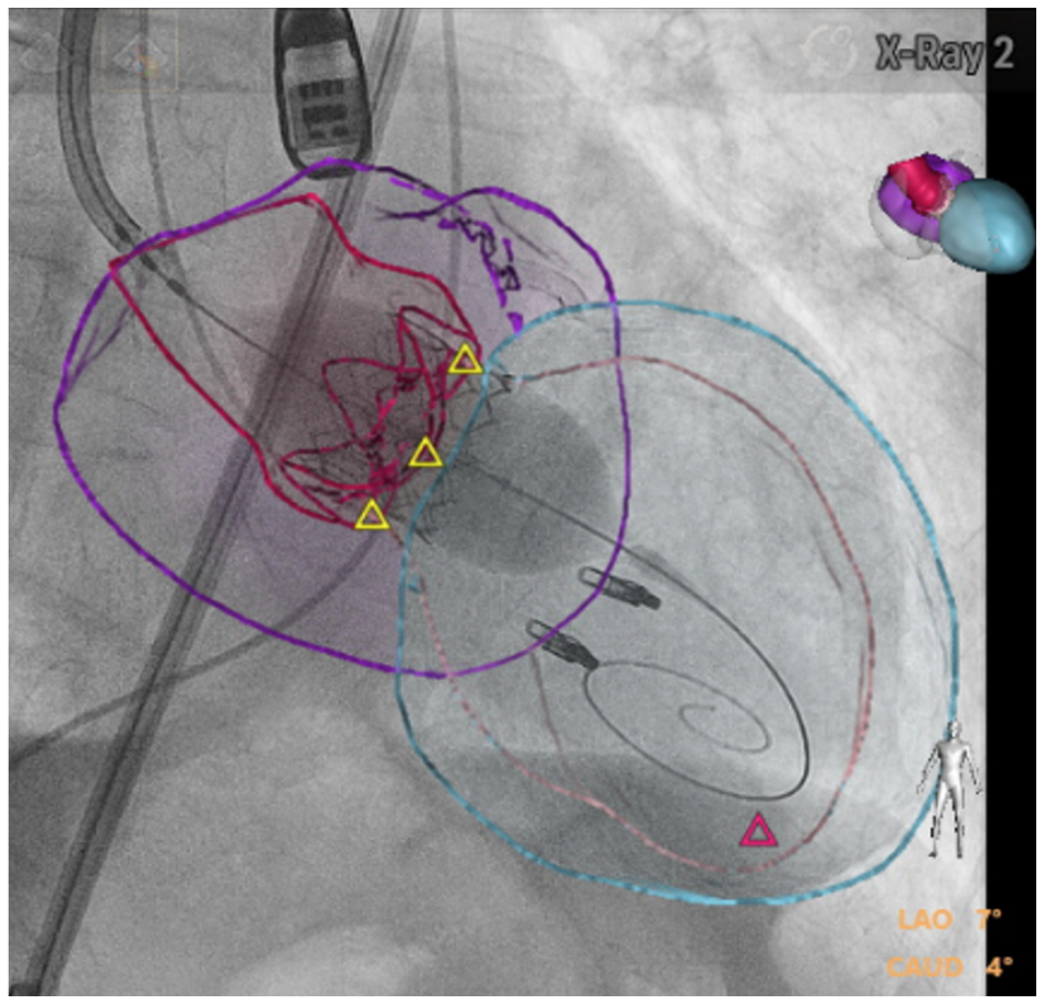 Oechslin TAVR Figure 1