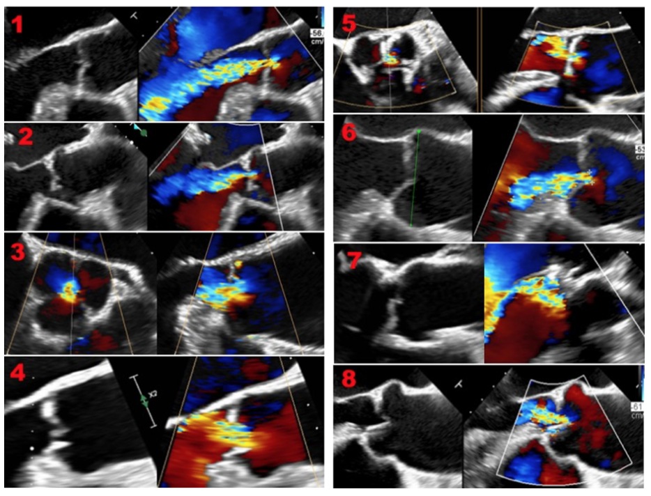 Oechslin TAVR Figure 2