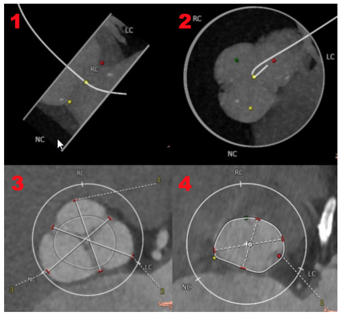Oechslin TAVR Figure 3