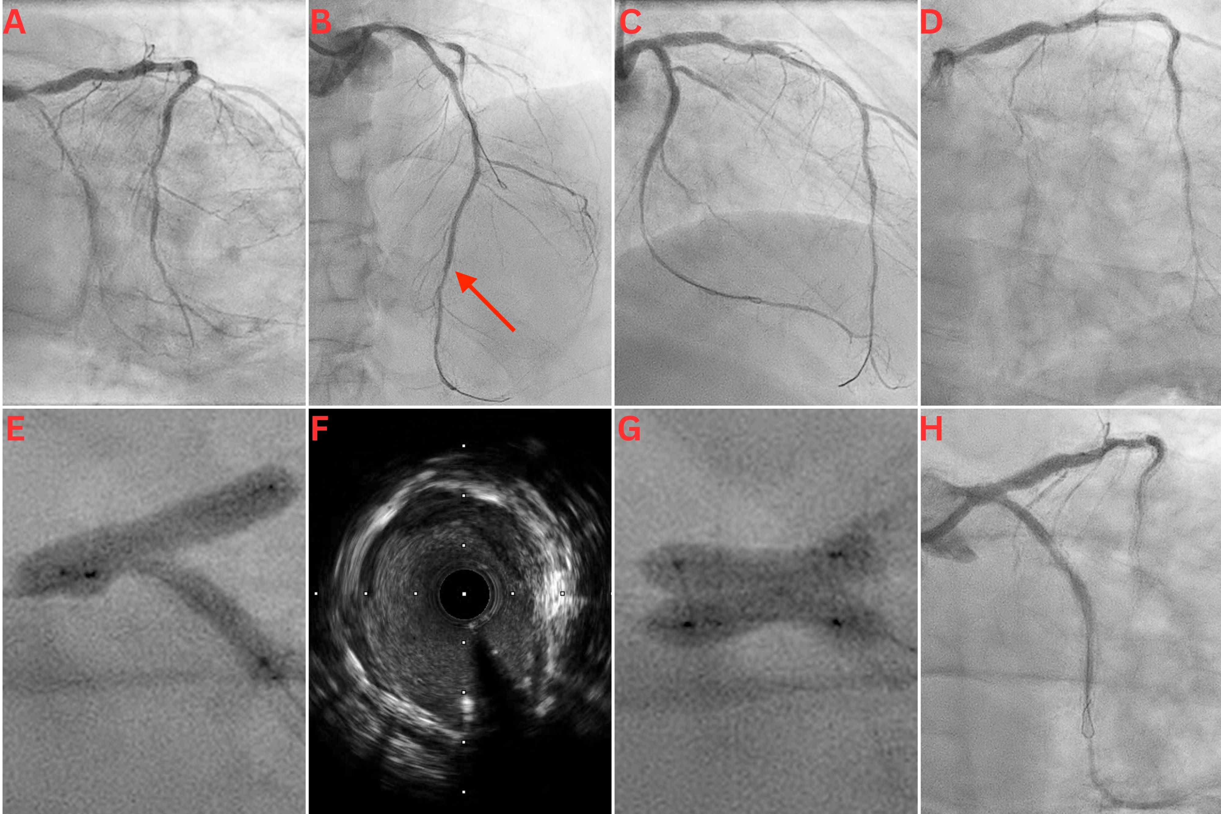 Figure. (A) Severe distal left main coronary artery