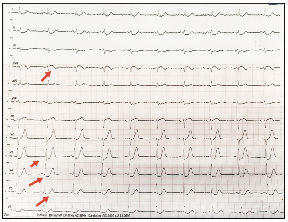 Olea LAD Occlusion Figure 1