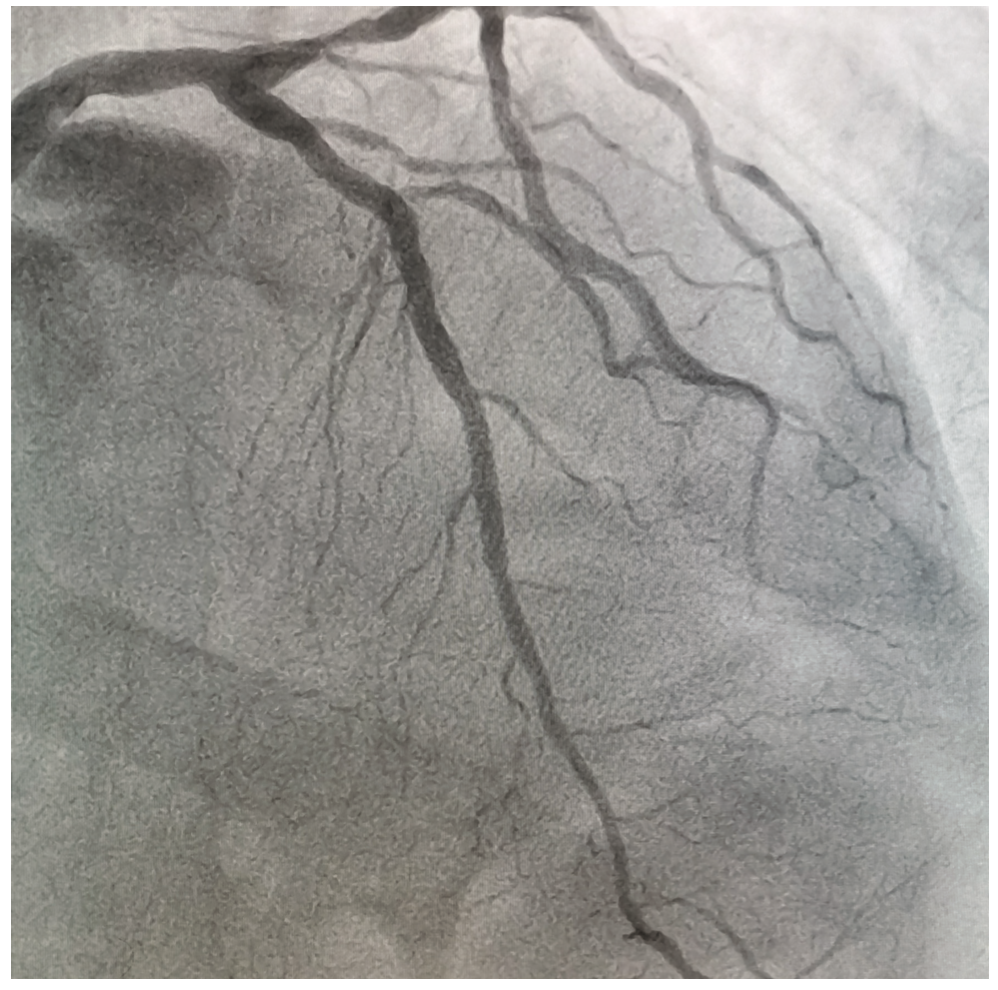 Olea LAD Occlusion Figure 4