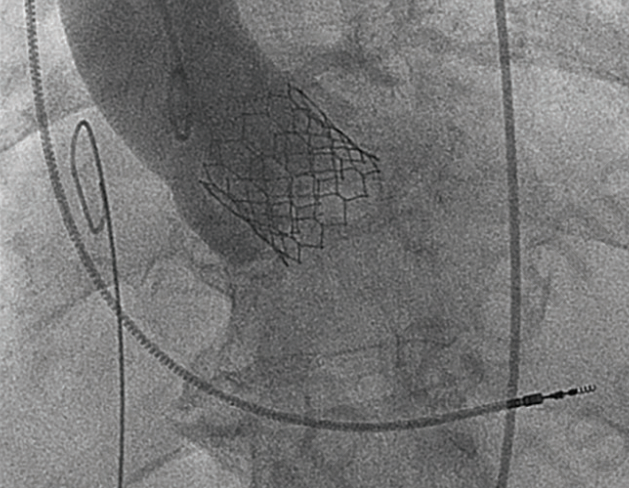 Ong May 2021 Journal of Invasive Cardiology