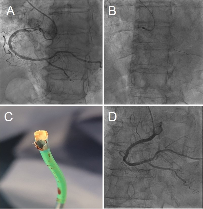 Figure. Accidental guide catheter machining during rotational atherectomy.