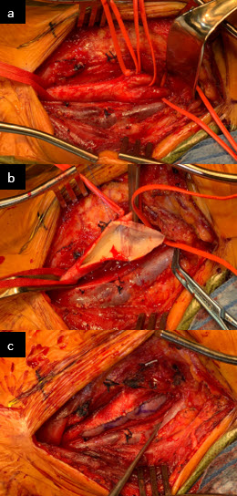 Figure 1. Exposure of the left common carotid artery (a), after opening of the artery and removal of the plaque (b), and after artery repair with the pBPP (c).