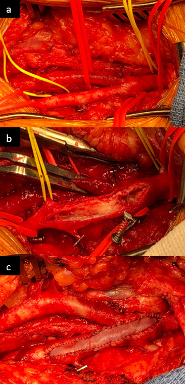 Figure 2. Exposure of the left femoral artery (a), after opening of the artery and prior to plaque removal (b), and after artery repair with the pBPP (c).