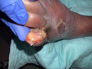 Figure 1. Here is the initial presentation of the foot. The patient had a history of type 2 diabetes mellitus and hypertension. He presented to the emergency department with 2 days  worsening left-sided abdominal pain radiating to his back, associated with fevers and chills. There was no nausea, vomiting, diarrhea or bloody bowel movements. 