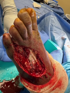 Figure 2. Here is the foot following extensive debridement. 