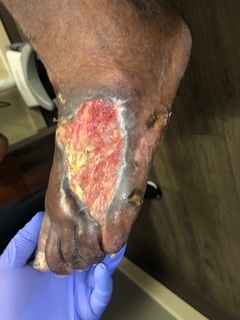 Figure 3. Placement of the synthetic matrix over the wound bed. 