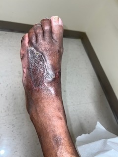 Figure 5. This post-grafting photo demonstrates early epithelialization and graft take. 