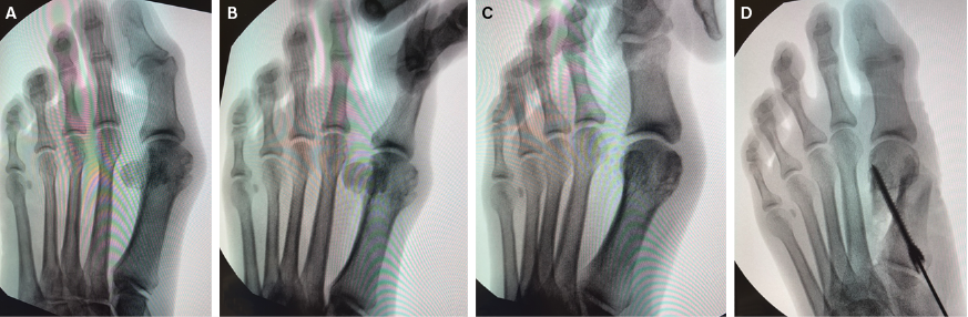Case 3. A. Intraoperative, preprocedure, non-weight-bearing AP radiograph. Note the intermetatarsal angle and sesamoid position. B. Intraop, preprocedure image. Prior to any surgical dissection, leaving the soft tissues intact, and maintaining the first MTPJ complex, one can see rotation of the great toe, sesamoids, and first metatarsal as one unit in valgus, increasing the deformity – note the valgus of the great toe. C. Intraop, preprocedure, AP non-weight-bearing radiograph prior to any surgical dissection, leaving the soft tissues intact, and maintaining the first MTPJ complex, here one can see rotation of the great toe, sesamoids, and first metatarsal as one unit in the varus direction, reducing the deformity.  Note the location of the sesamoids and the position of the great toe are no longer in valgus. D. AP non-weight-bearing intraop view post-reduction and fixation. Note the sesamoid alignment without any dissection performed to obtain the reduction.