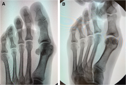 Case 4. A. Intraoperative non- weight-bearing AP radiograph. B. Intraoperative non-weight-bearing AP radiograph exhibiting reduction while leaving the soft tissues intact, once the completing and reducing the osteotomy.