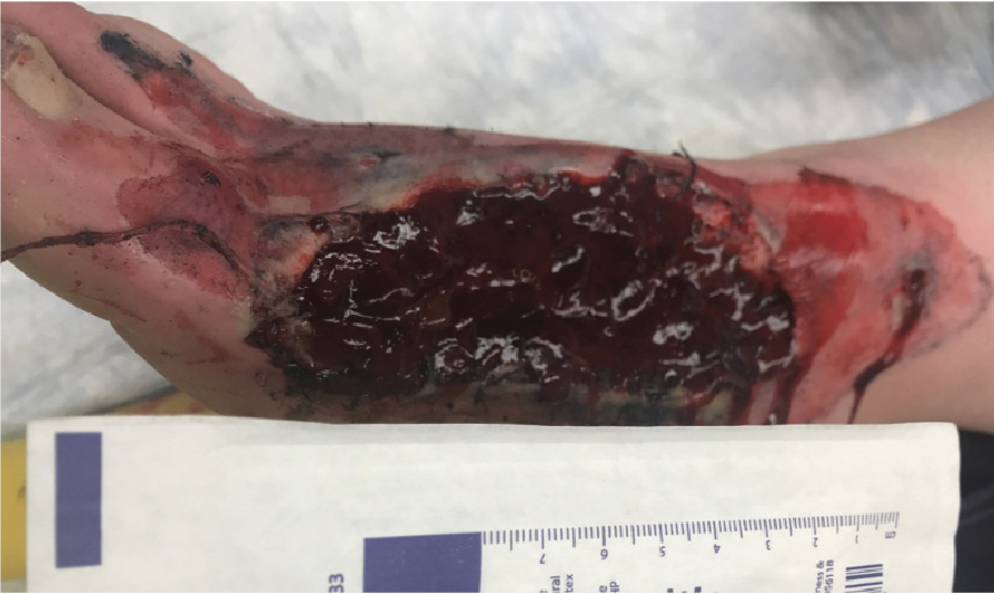 Figure 1. Initial presentation of the right foot degloving injury.