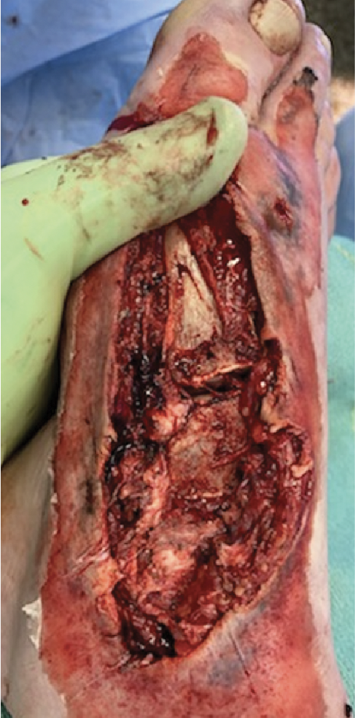 Intraoperative findings included periosteal stripping of the first metatarsal and medial cuneiform, nondisplaced fractures of the first and second metatarsal heads, a small medial cuneiform avulsion fracture, rupture of the tibialis anterior tendon, denuded extensor hallucis longus tendon, and complete disruption of the medial dorsal cutaneous nerve