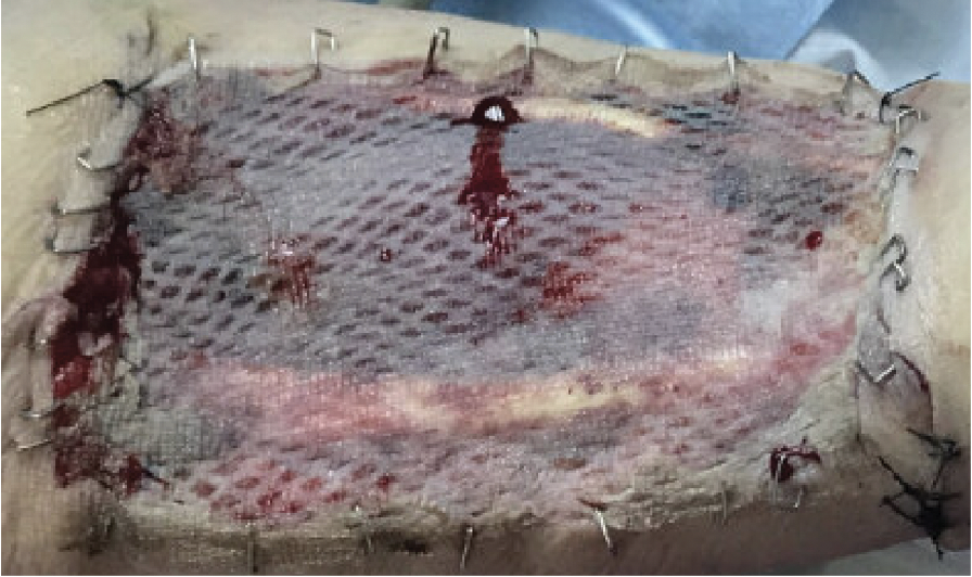 Figure 4. Free radial forearm flap donor site on postoperative  day 5.