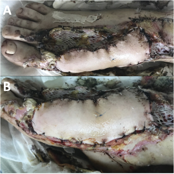Figure 5. Postoperative day 5 appearance of the right foot after free tissue transfer and split-thickness skin grafting. A, dorsal view. B, medial view.